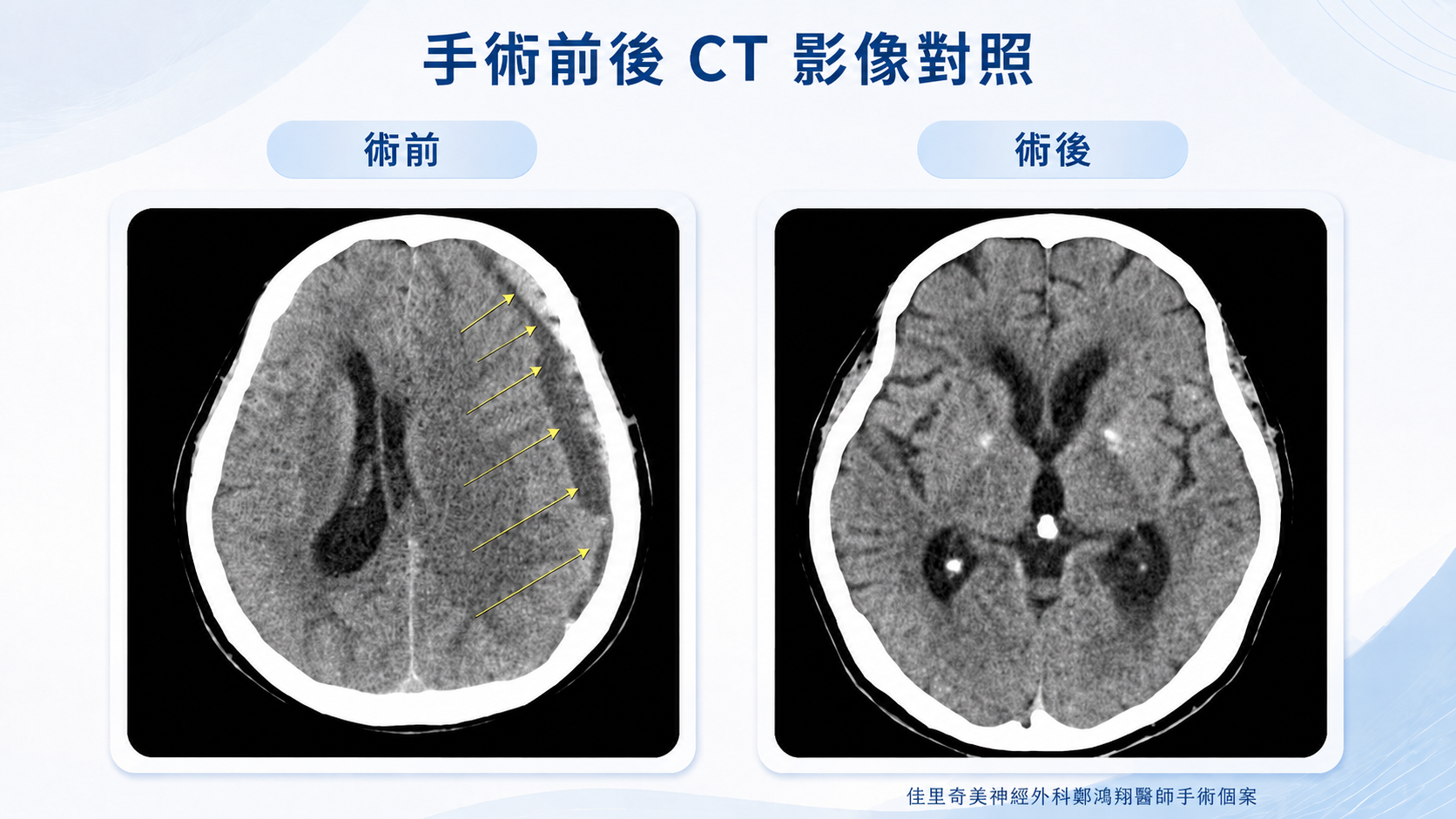慢性硬腦膜下出血手術前後 CT 影像對照
